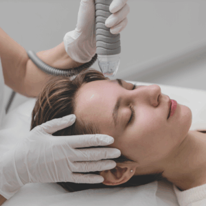 Vivace RF Microneedling: East Bay’s Science-Backed Shortcut to Radiant Skin
