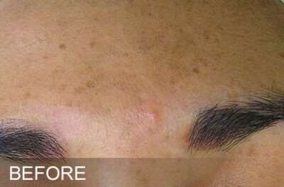 HydraFacial Before & After Photos