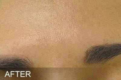 HydraFacial Before & After Photos