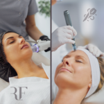 RF vs SkinPen Microneedling BlossomMD East Bay